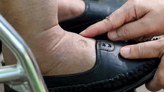 Ai picioare umflate? Boli grave care pot fi semnalate de aces simptom. Nu e de la consumul excesiv de sare și nici de la încălțăminte!