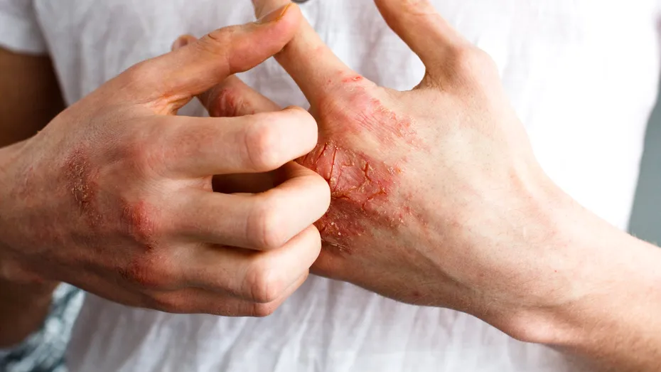 Eczema: cauze, simptome, tratament, prevenţie