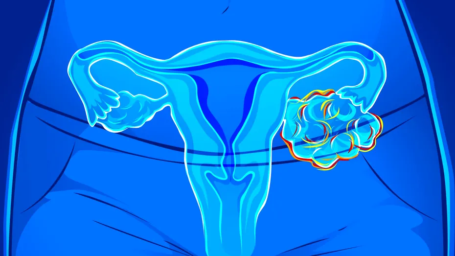 Cancerul ovarian atacă și fetele sub 18 ani! Factori de risc și primele semnale de alarmă
