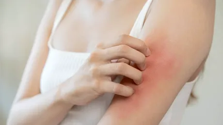 Dermatita atopică: 10 soluții care te ajută să oprești mâncărimea