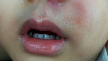 Celulita infecţioasă: cauze, simptome, tratament, prevenţie