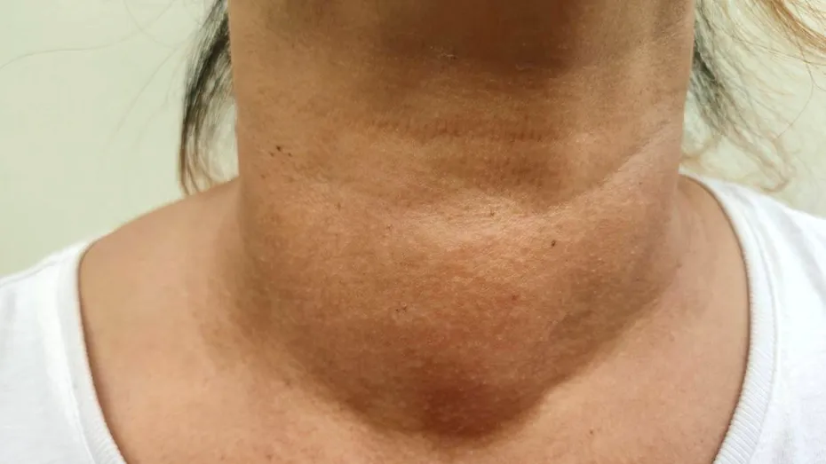 Câte kilograme te poți îngrășa cu adevărat de la tiroidă. „Este un aspect tipic pacientului hipotiroidian. Este pufos”