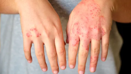 Semnul că tratamentul tău pentru psoriazis nu mai funcționează. Medicii spun când trebuie schimbat