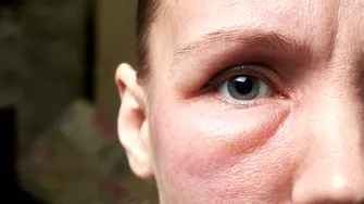 Semnele ascunse ale problemelor renale. Ce spun ochii umflați