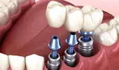 Dinți ficși în 24 de ore: mit sau realitate? Tot ce trebuie să știi dacă te-ai hotărât să-ți pui un implant dentar