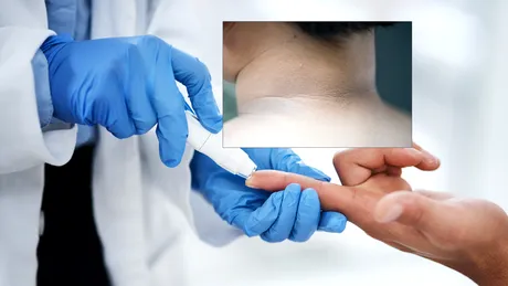 Medicii avertizează: o pată închisă la culoare pe piele poate fi un semn al diabetului de tip 2