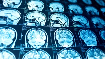 Este grupa de sânge legată de riscul de AVC înainte de 60 de ani? Ce spun studiile recente