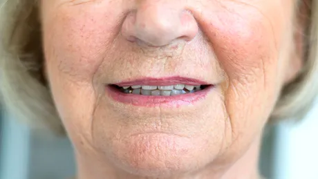 Subțierea buzelor și ridurile din jurul gurii, consecințele unei probleme dentare care afectează mulți români