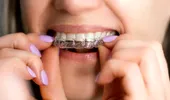 Ortodonția în 2025 – nu mai e ce era: fără brackets, fără metal, fără vizite lunare. Simplu, dar eficient, în același timp