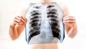 Tuberculoză sau COVID-19? Vezi diferenţele şi asemănările