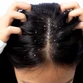 Cum să scapi de mătreață fără șampoane scumpe. Secretul pentru un scalp sănătos