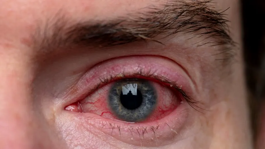Planul alimentar pentru recuperarea conjunctivitei: alimente recomandate și alimente de evitat pentru vindecare rapidă și protecția ochilor