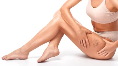 Picioare frumoase și sănătoase: Perspectiva dermatologului asupra insuficienței venoase