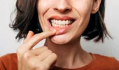 Trend pe TikTok: tinerii își zgârie dinții și gingiile ca să scape de tartru acasă. De ce este periculos!