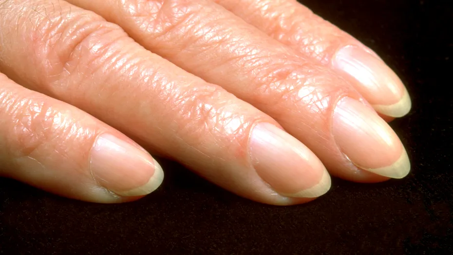 Semnul timpuriu de pe degete care ascunde cel mai temut cancer. Aproape 40% din bolnavi au acest simptom