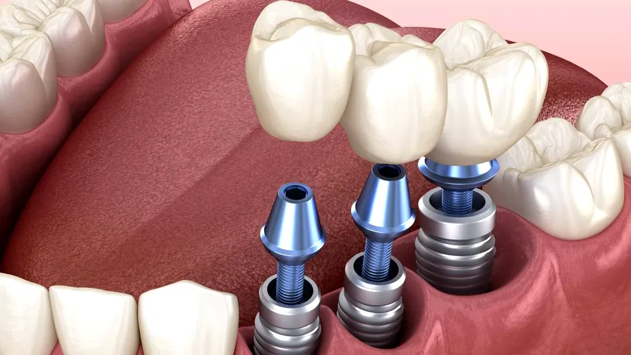Dinți ficși în 24 de ore: mit sau realitate? Tot ce trebuie să știi dacă te-ai hotărât să-ți pui un implant dentar