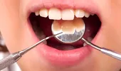 10 mituri despre plombe dentare şi carii