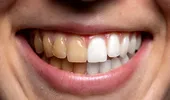 Ce băutură îți pătează dinții cel mai mult: Cola, cafeaua sau vinul roșu? Experimentul unui dentist te va uimi