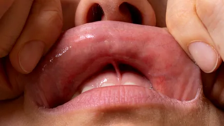 Semnul care apare pe buză la bătrânețe și crește riscul de demență. La ce să fii atent