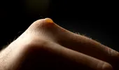 De ce apar bășicile pe piele și cum scăpăm de ele