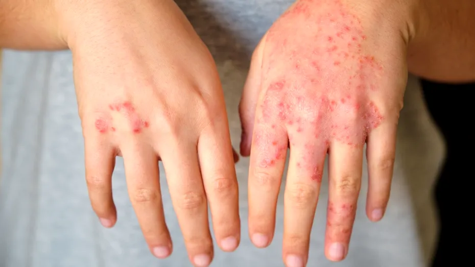 Semnul că tratamentul tău pentru psoriazis nu mai funcționează. Medicii spun când trebuie schimbat