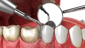 Detartrajul dentar – ce probleme apar dacă nu mergi la dentist pentru îndepărtarea tartrului