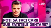 Poți să faci carii sub fațetele dentare?
