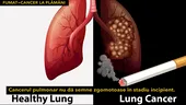 Boala gravă pe care o fac majoritatea celor care fumează VIDEO by CSID
