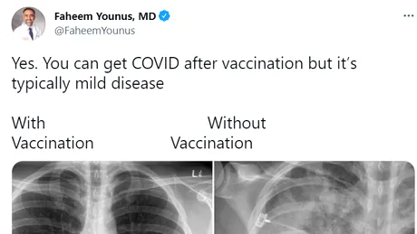 Cum arată plămânii unui bolnav de COVID nevaccinat versus ai unui pacient imunizat