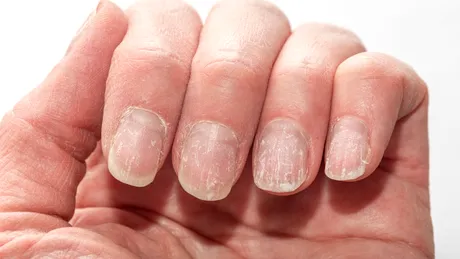 Unghiile pot semnala boli grave. Semnul discret care poate indica probleme ale inimii, ficatului sau rinichilor