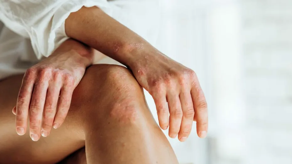 Remediu naturist împotriva psoriazisului: calmare și hidratare profundă cu ingrediente naturale