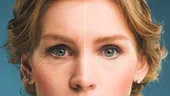 Mit sau adevăr în estetica facială - despre acidul hialuronic