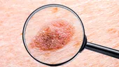 Cancerul de piele - semnele celor mai frecvente tipuri de cancere cutanate