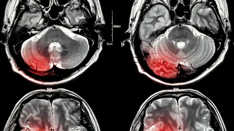 Accidentul vascular cerebral hemoragic
