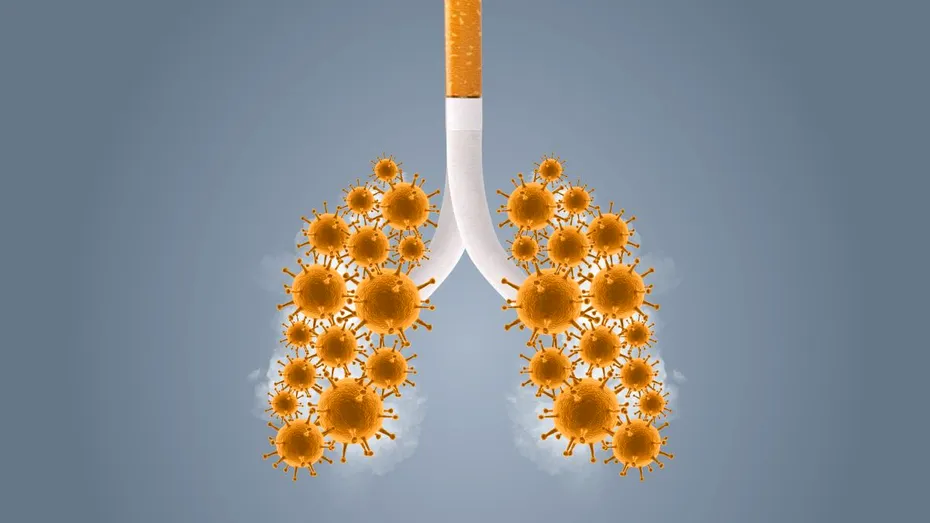 Pneumolog: Fumătorii cu BPOC riscă să dezvolte forme grave de COVID-19