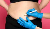 Prima vară după chirurgia bariatrică: cum îți schimbi corpul, dar și relația cu tine însuți
