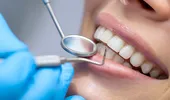 Avantajele şi dezavantajele faţetelor dentare