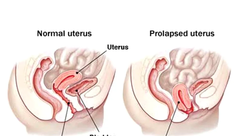 Prolapsul uterin: simptome si tratamente