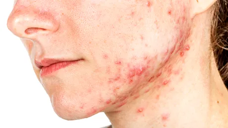 De ce apar și cum se tratează coșurile pe linia mandibulei