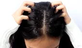 Remedii naturale pentru combaterea mătreții. Soluții simple pentru un scalp sănătos