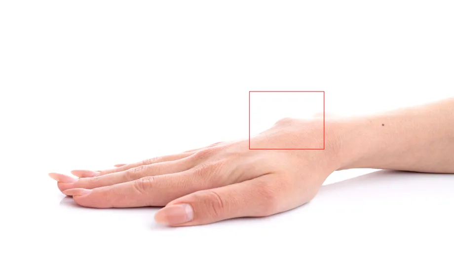 Ce este chistul sinovial și când devine o problemă?