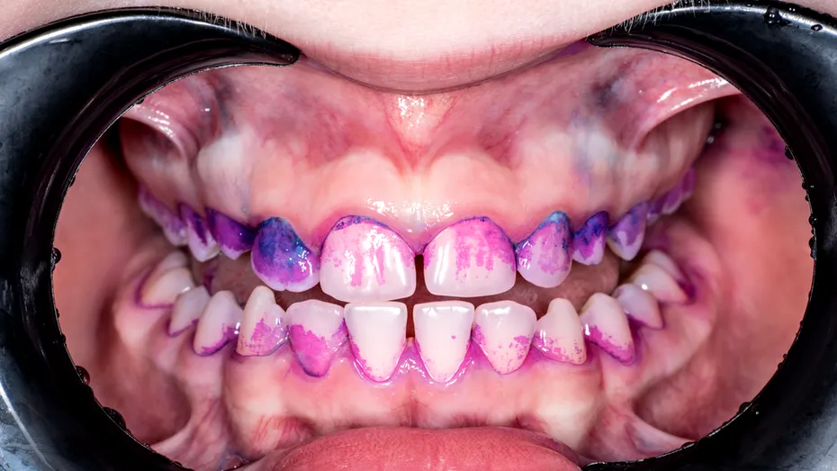 Ai dinții galbeni sau gri? Ce spune culoarea dinților despre sănătatea ta