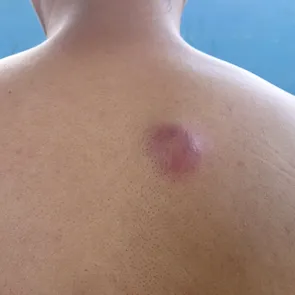 De ce nu trebuie spart un furuncul: recomandări și tratament