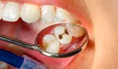 Știai că există mai multe tipuri de carii dentare și că cele negre nu sunt cele mai periculoase?
