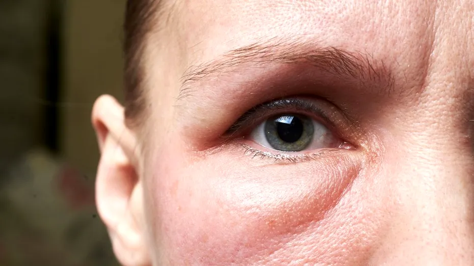 Te trezești cu fața umflată? Ce alimente și boli pot duce la umflarea feței