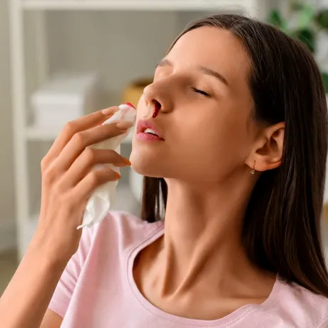 Sângerările nazale: Cauze comune și când trebuie să te îngrijorezi