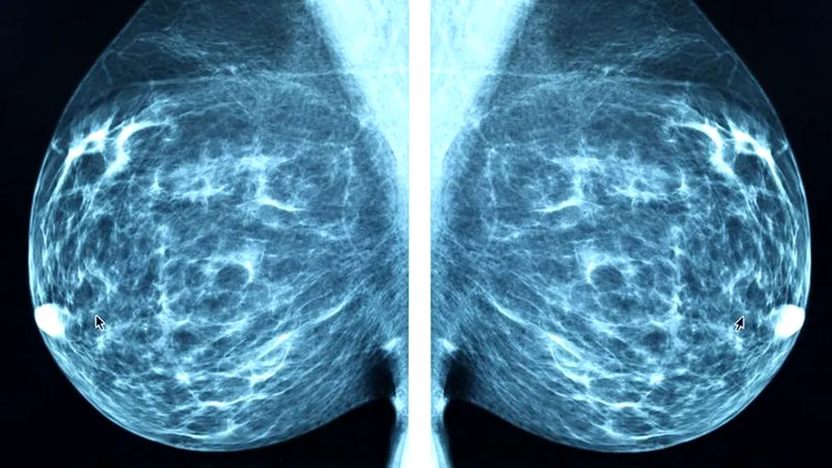 Ecografie, mamografie sau RMN pentru depistarea cancerului de sân?
