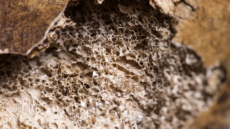 Boala tăcută care ne macină oasele. Afectează una din trei femei cu vârsta peste 50 de ani