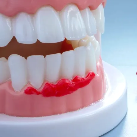 Cum scapi rapid de sângerări gingivale cu ajutorul laserului