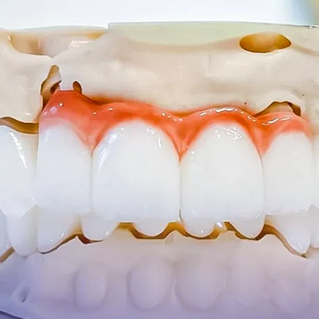 (P) Estetică fără compromis: De ce implantul dentar e cea mai naturală soluție